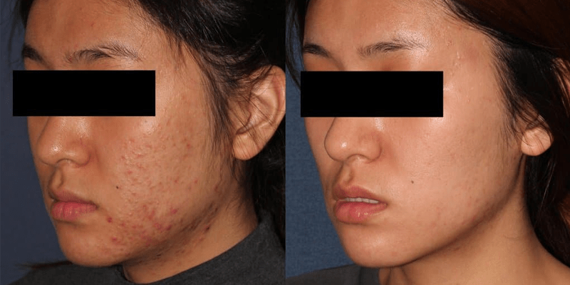 Microneedling Asian Skin Female before and after photo