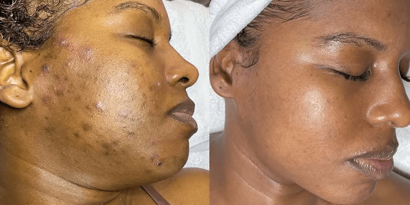 Microneedling Before and After. Black Female treated for Acne and Hyperpigmentation