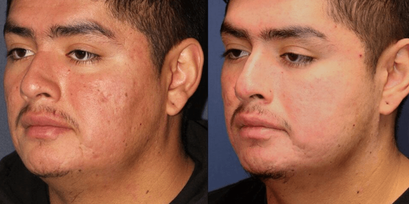 Microneedling Treatment before and after photo. Hispanic male treated for acne and scarring.