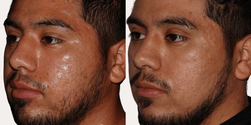 Microneedling Treatment Before and After Photo. Hispanic male treated for acne and scarring