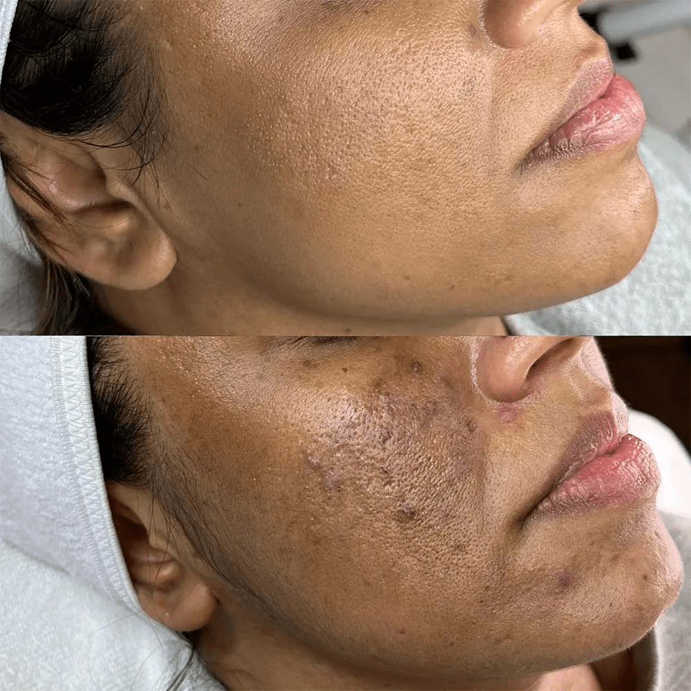 Microneedling before and after photo: Black Female Hyperpigmentation