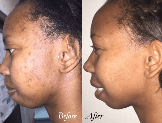 Microneedling Black Skin Female before and after photo