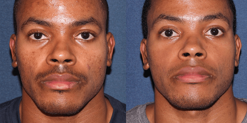 Microneedling Black Skin Male Before and After Photo 1