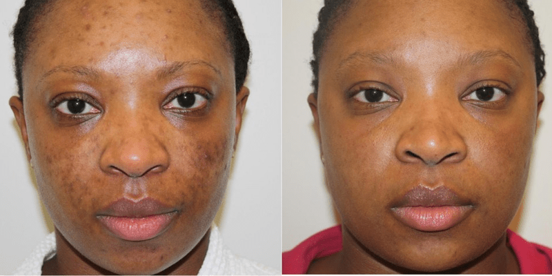 Microneedling Black Skin Female Before and After 