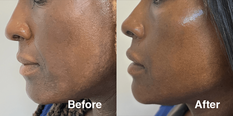 Microneedling Black Skin Female Before and After Photo 2