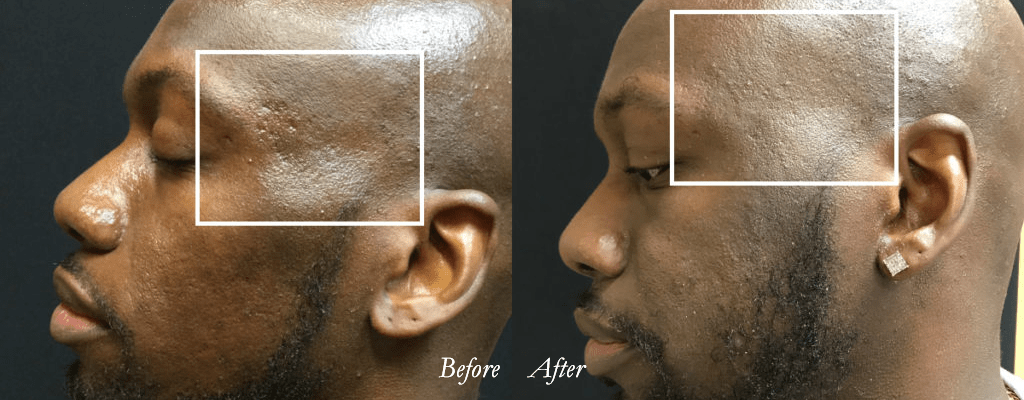 Microneedling Black Skin Male Before and After
