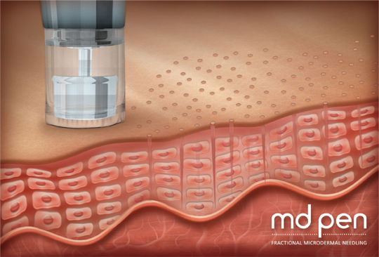 MD Pen Microneedling Technology