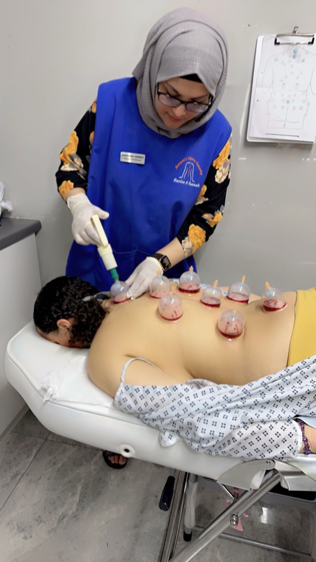Hijama cupping on knees