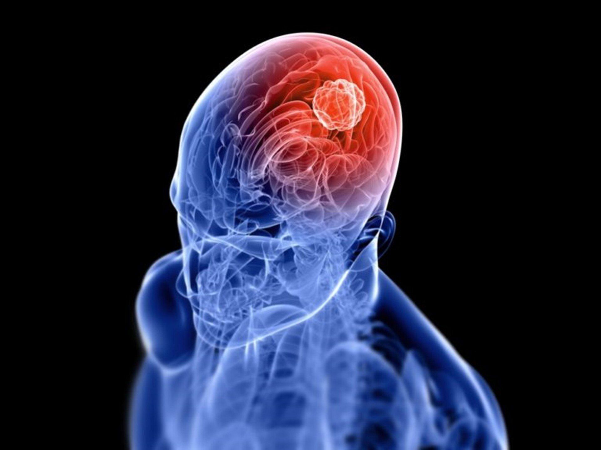 Pituitary tumors and dizziness