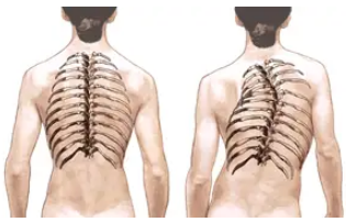 Scoliosis spine vs. healthy spine