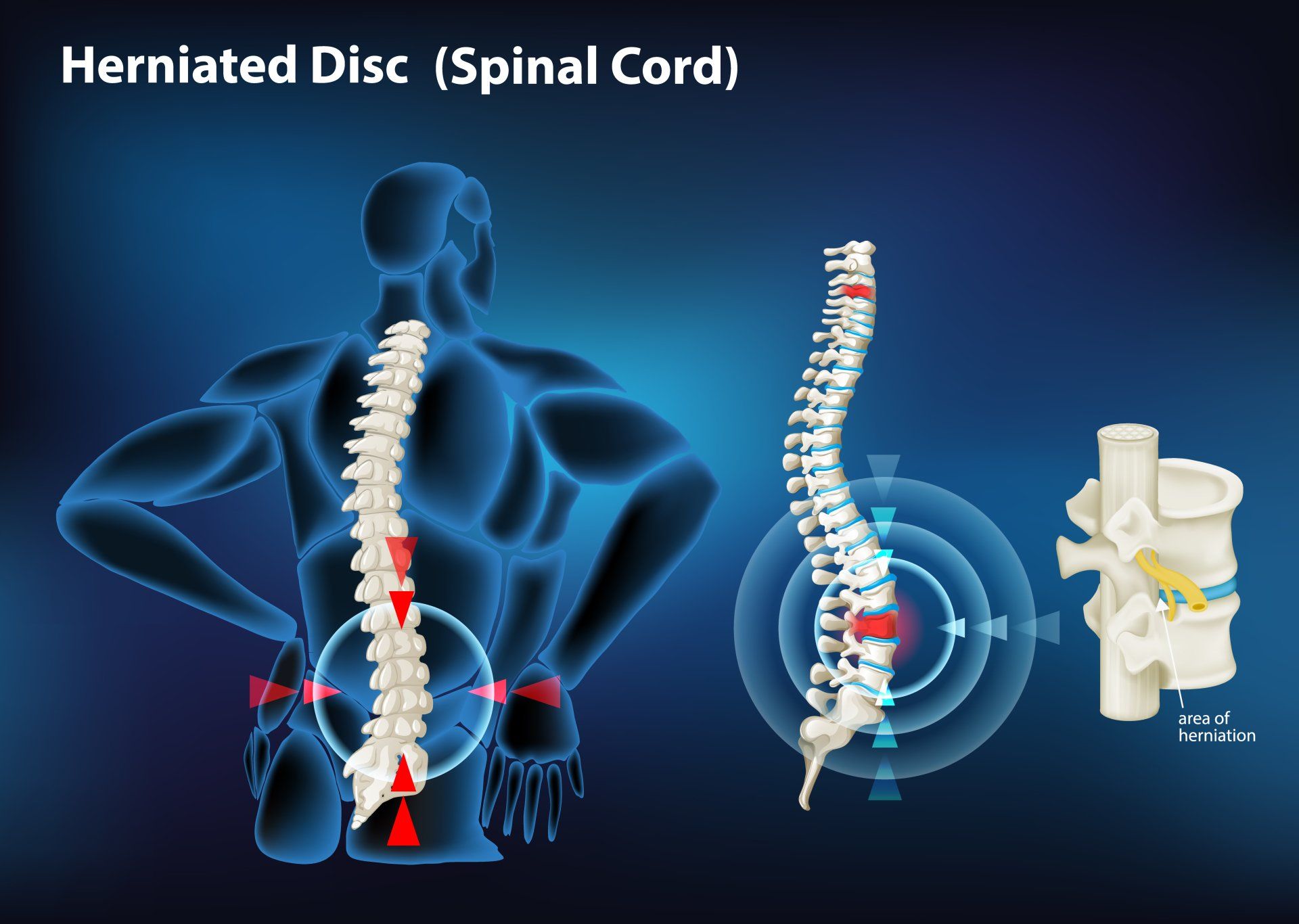 How to deal with Herniated Disc