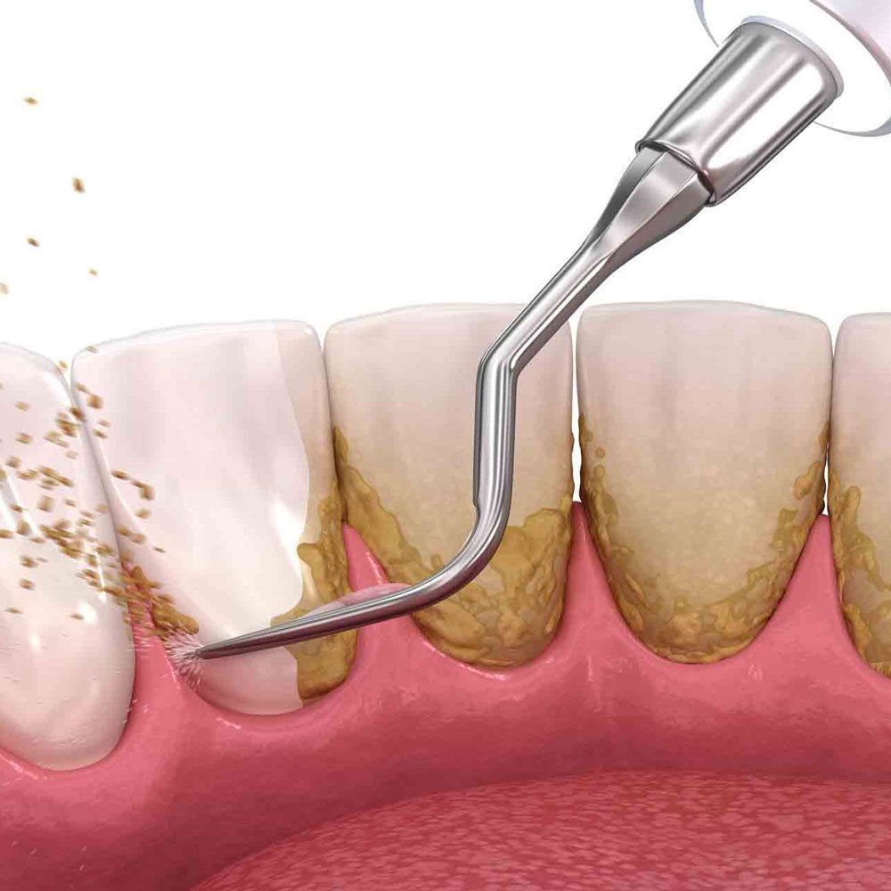 Whitening Teeth — Portage, IN — Airport Road Dental Associates, PC