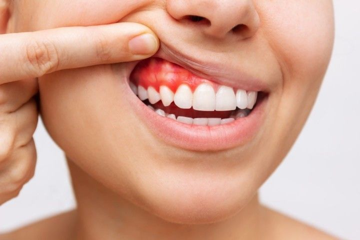 Treat Gum Disease
