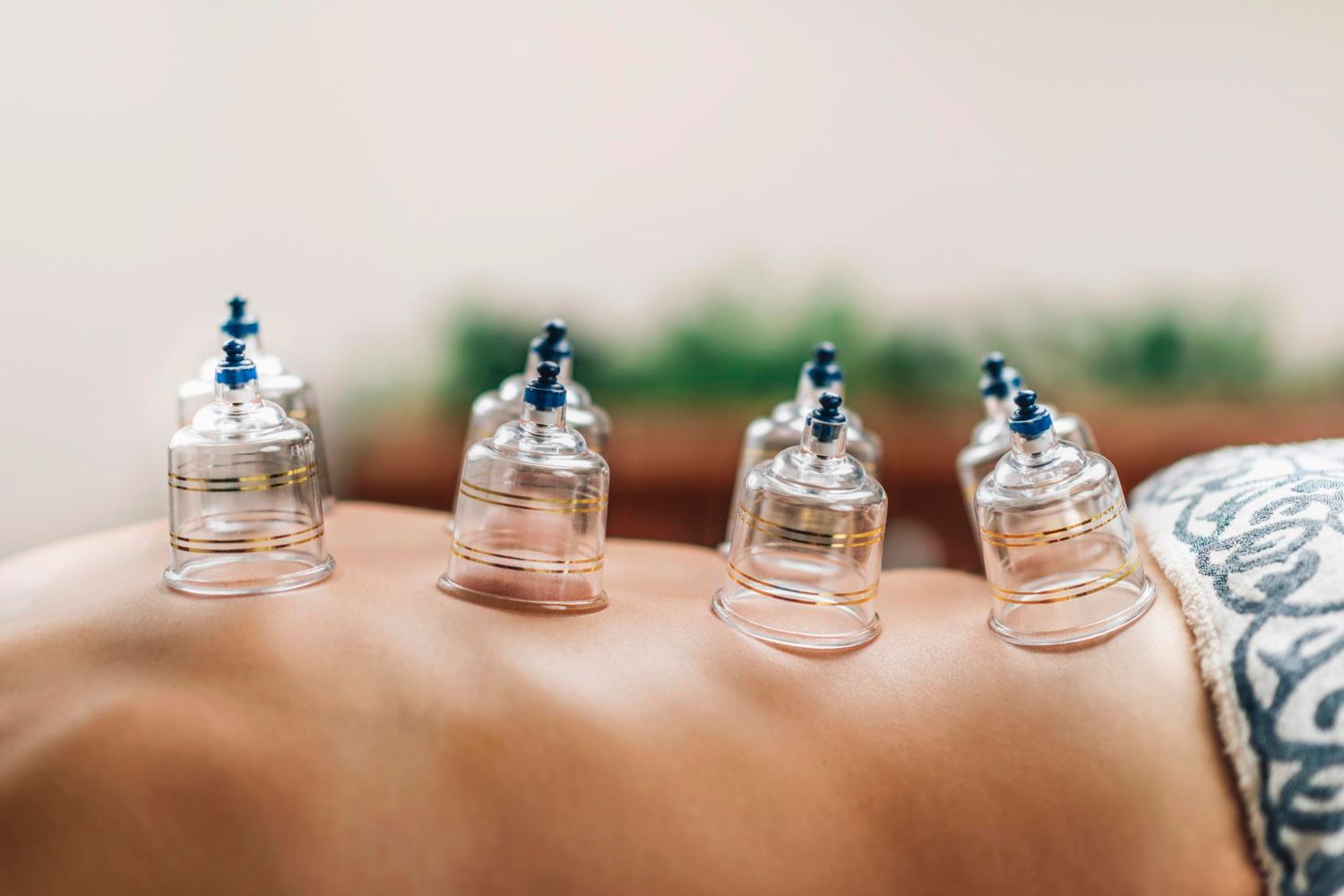 Clear plastic suction cups applied to a person's bare back during a cupping therapy session.