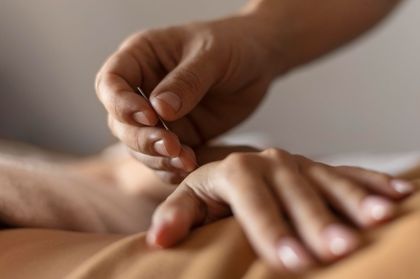 A practitioner holds an acupuncture needle above a person’s skin, preparing to insert it.