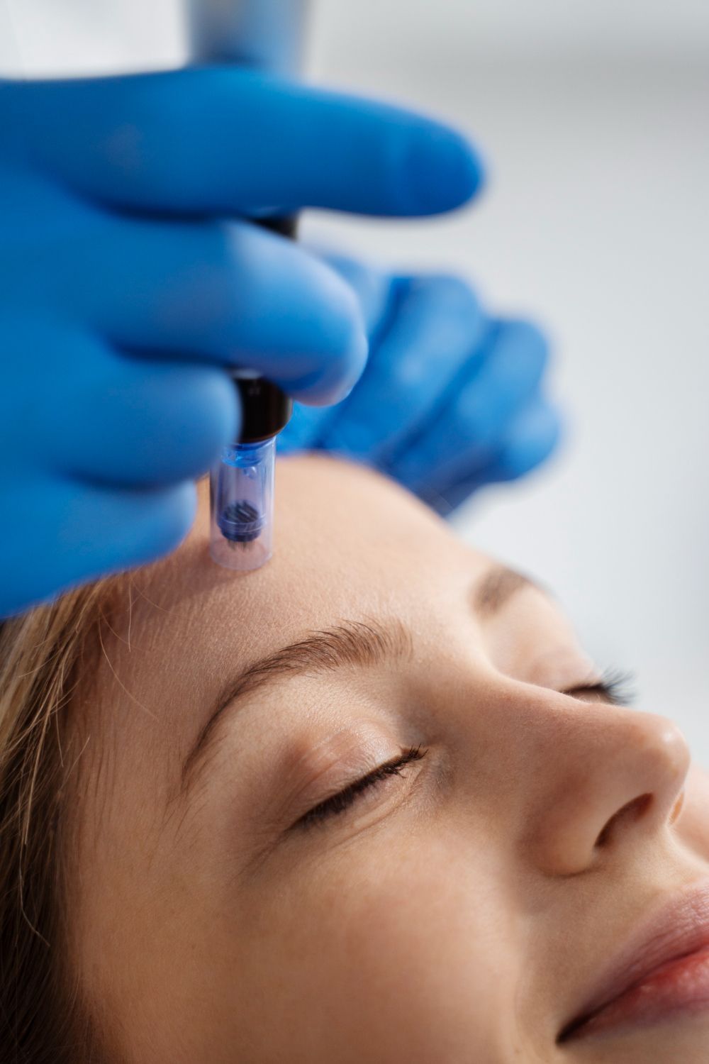 A practitioner wearing blue medical gloves performs microneedling on a person's forehead.