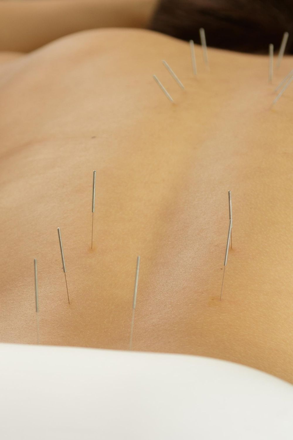 Several acupuncture needles are inserted into the skin of a person's upper back.