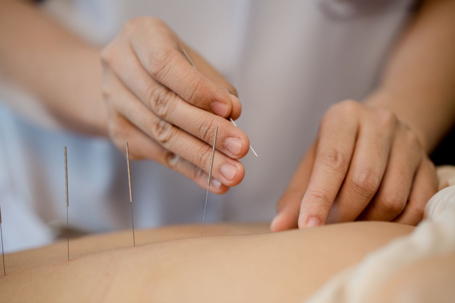A practitioner inserts an acupuncture needle into a patient's back, where several other needles are already placed.