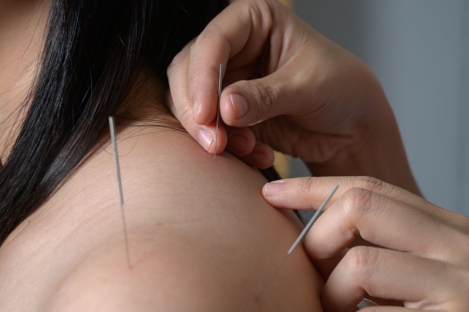 A practitioner performing acupuncture on a person’s shoulder, with two thin needles inserted into the skin.