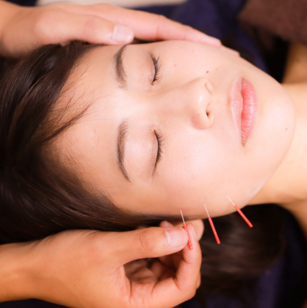 A practitioner places acupuncture needles into a person's cheek during a cosmetic acupuncture treatment.