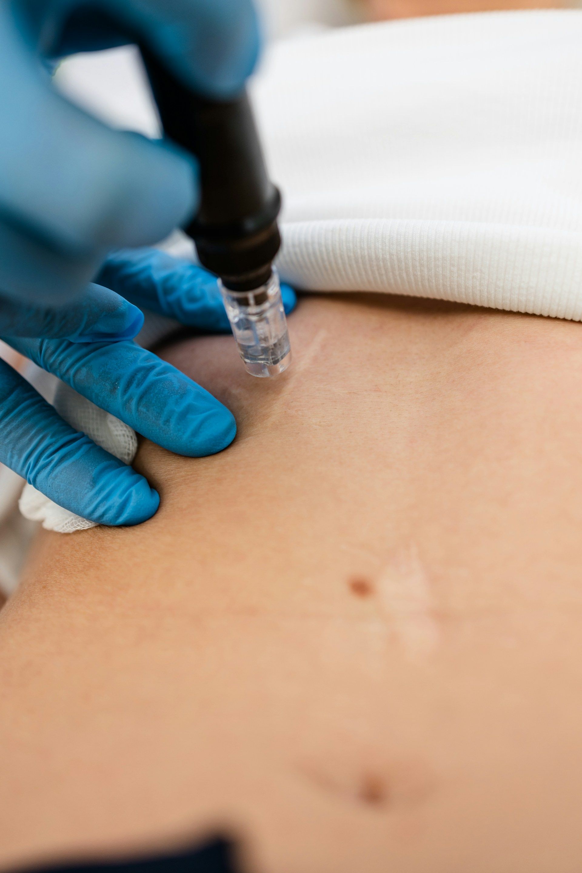 A gloved hand uses a microneedling device on a person's skin to treat scars.