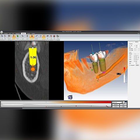 Chirurgia implantologia software assistita.