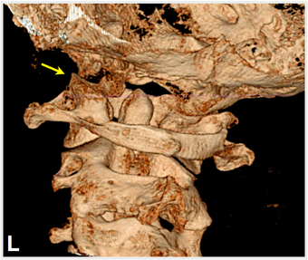 A ct scan of a person 's neck with a yellow arrow pointing to the left