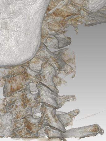 A close up of a ct scan of a person 's neck and spine.