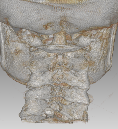 A computer generated image of a skull and neck.