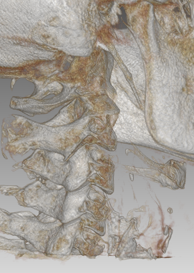 A close up of a ct scan of a person 's neck and skull.