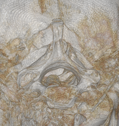 A close up of a ct scan of a skull and neck.