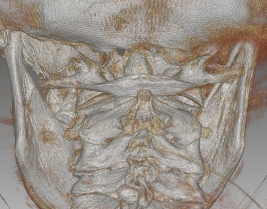 A 3d ct scan of a skull and neck.