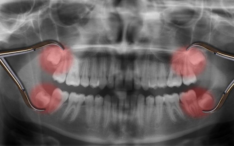 Impacted Tooth