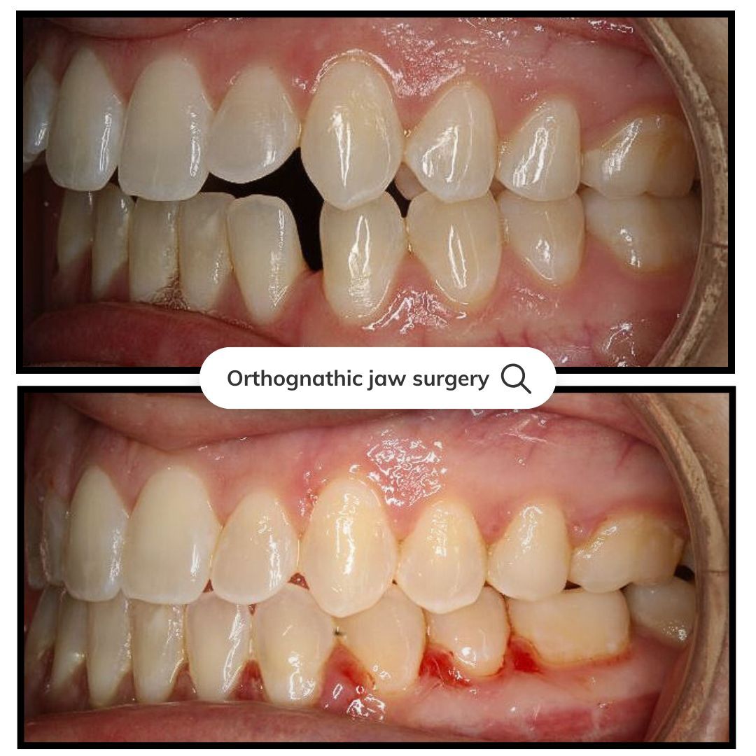 Before and after photos showing teeth alignment changes after jaw surgery.