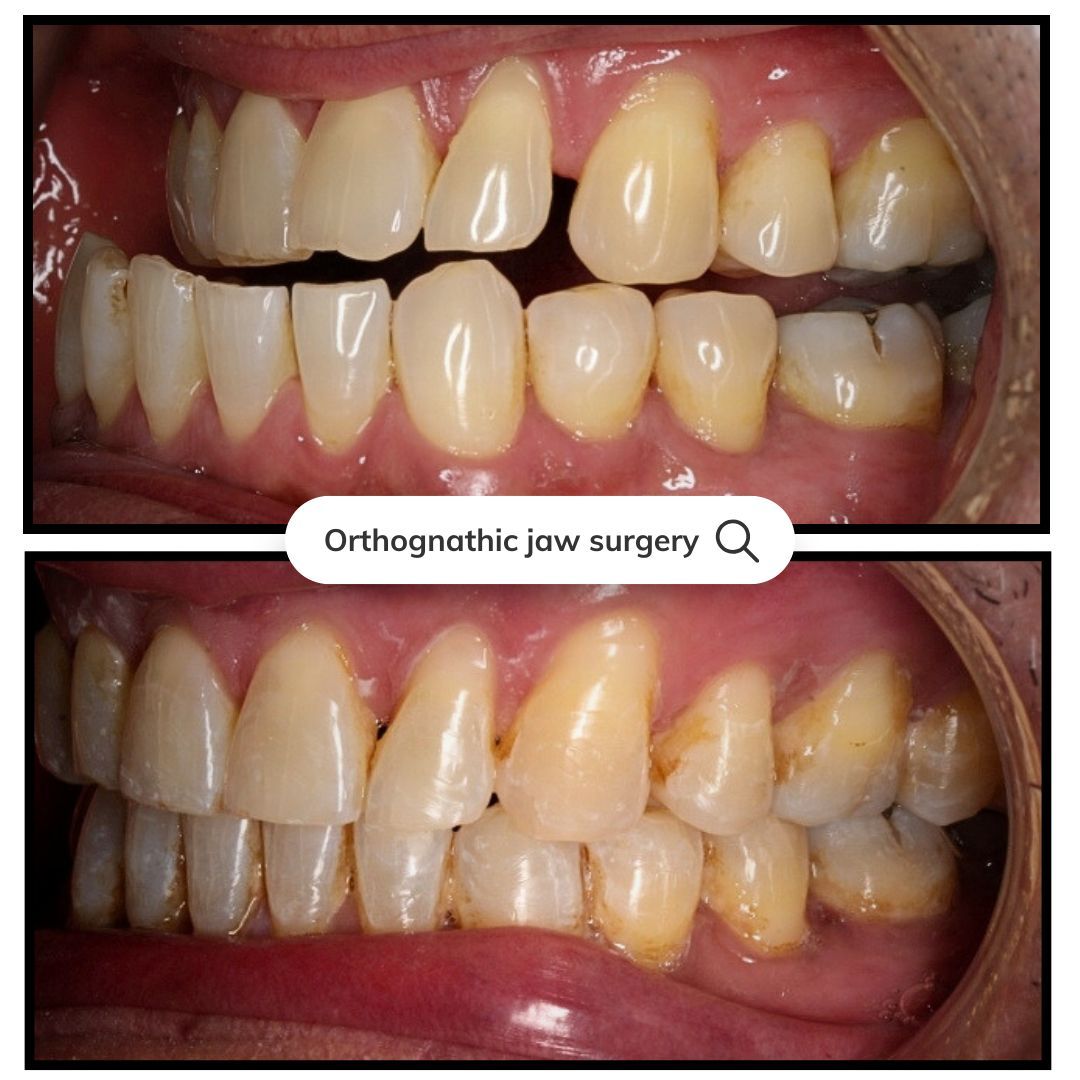 Comparison of misaligned teeth before and after orthognathic jaw surgery.