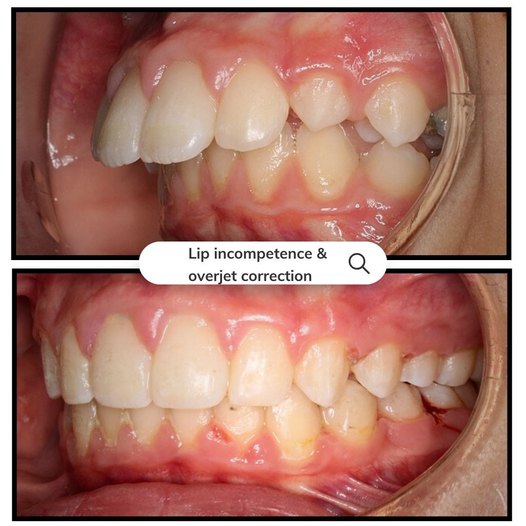 Comparison of teeth before and after overjet correction, addressing lip incompetence.