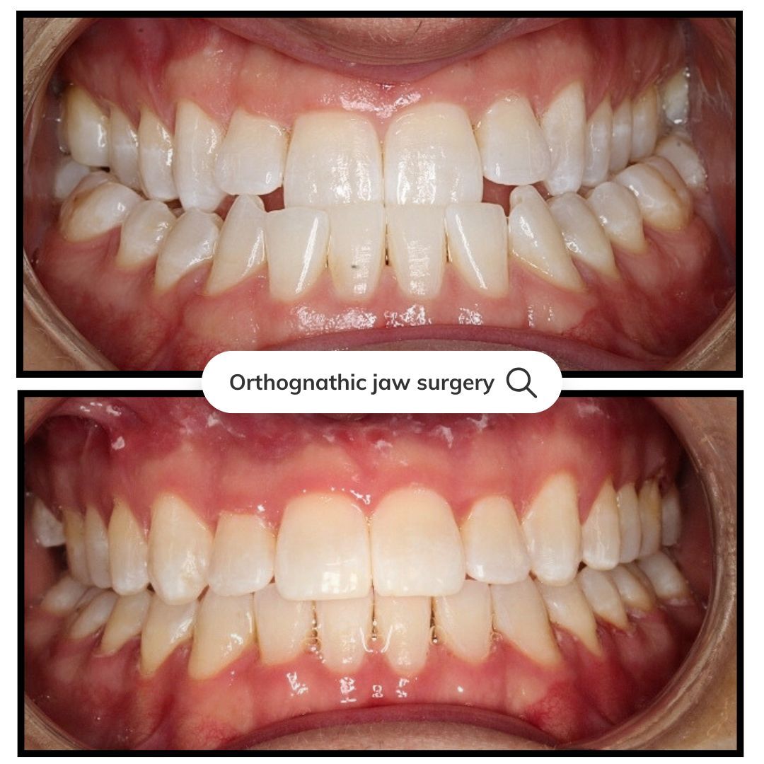 Before and after photos showing teeth alignment changes after jaw surgery.