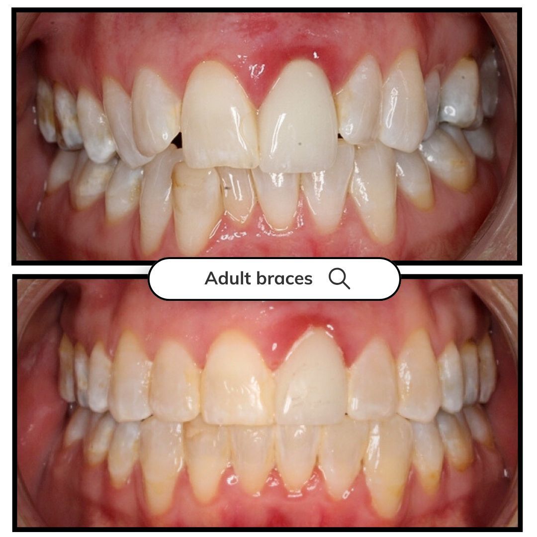 Comparison of teeth before and after adult braces, showing straighter alignment.