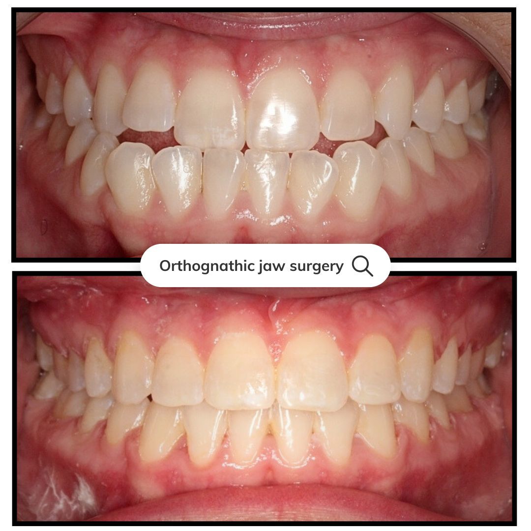 Before and after of teeth. Top teeth are crooked. Bottom teeth are straight.