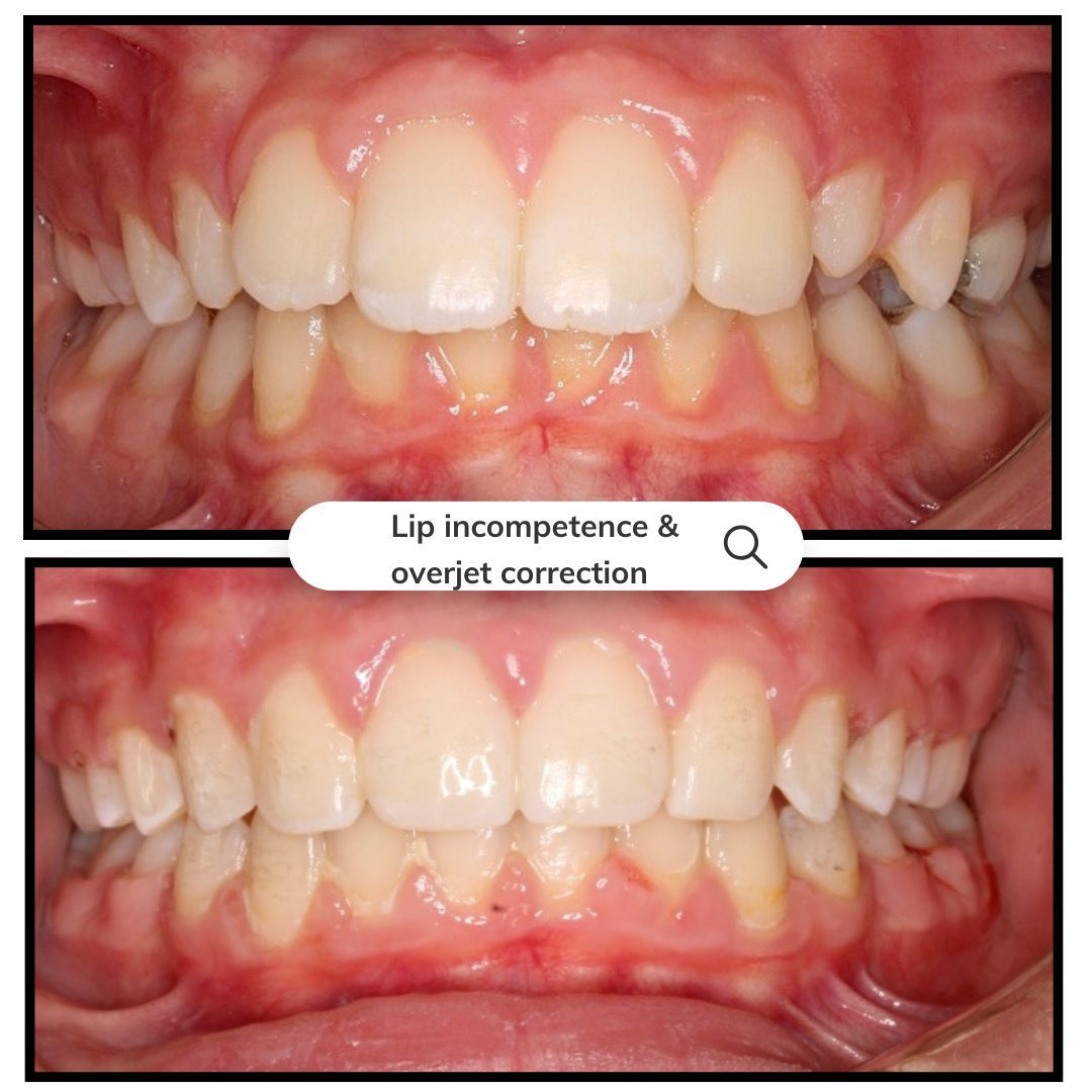 Two sets of teeth before and after orthodontic treatment. Top shows lip incompetence, bottom shows correction.