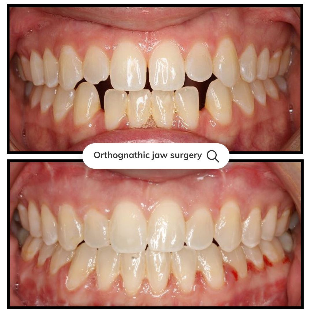 Before-and-after of teeth. Top row shows crowded teeth, bottom row shows straightened teeth after surgery.