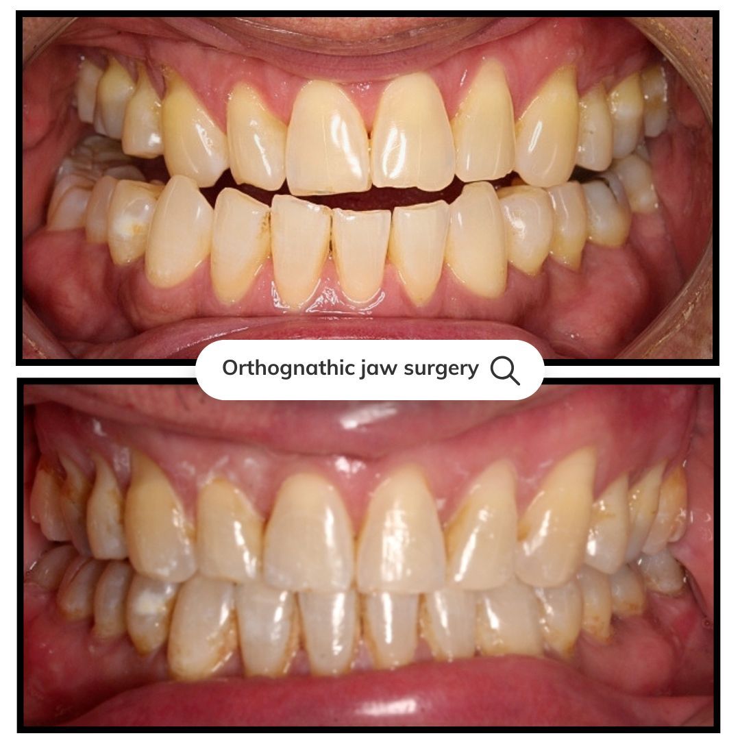 Comparison of teeth before and after orthognathic jaw surgery, showing improved alignment and bite.