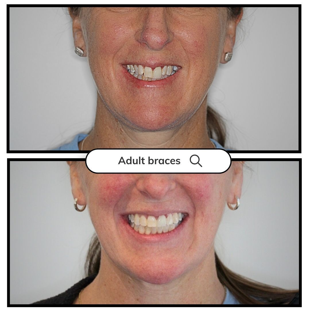 Before and after of a person's teeth, showing improvement after adult braces.