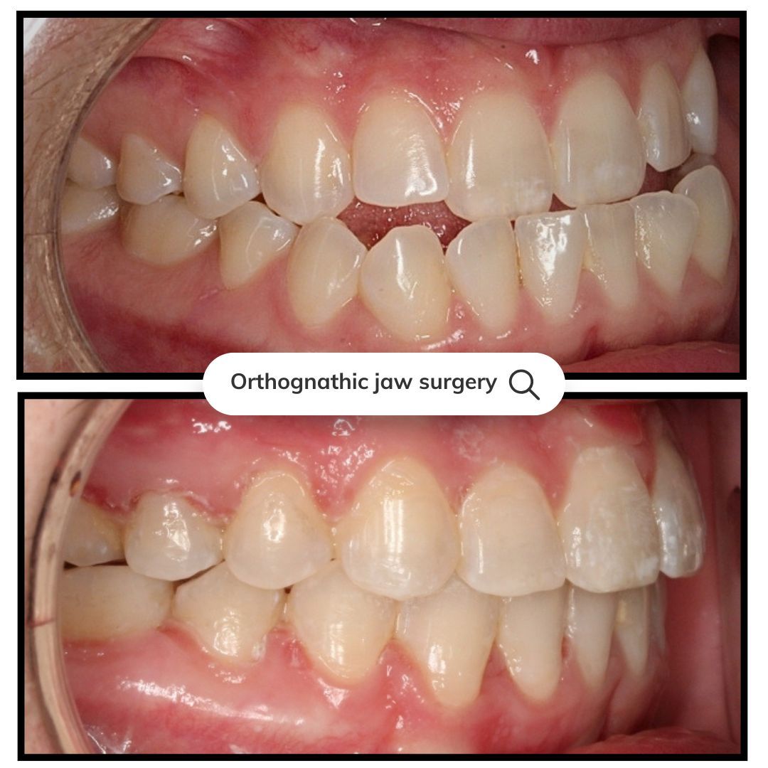 Two views of teeth: before and after orthognathic jaw surgery, showing improved alignment.