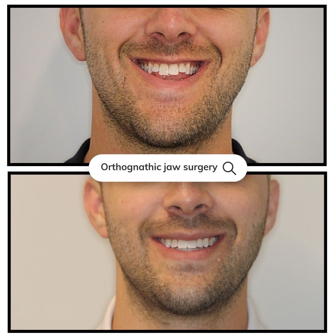 Comparison of a man's smile before and after orthognathic jaw surgery, showing improved tooth alignment.