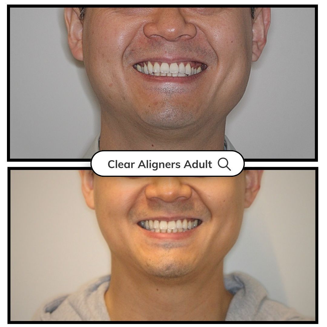 Before-and-after comparison of a smiling mouth, labeled 