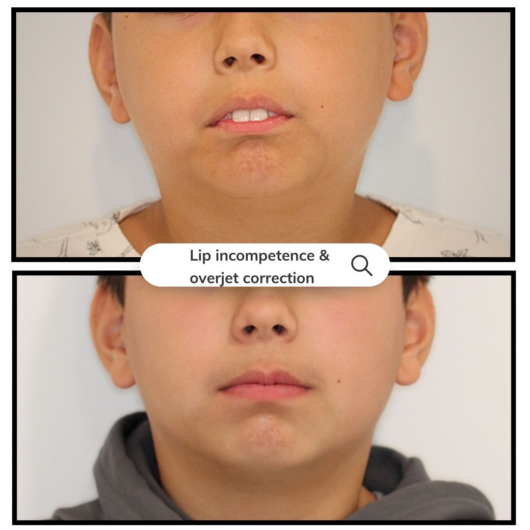 Before-and-after photos of a child with lip incompetence and overjet correction: top, before; bottom, after.