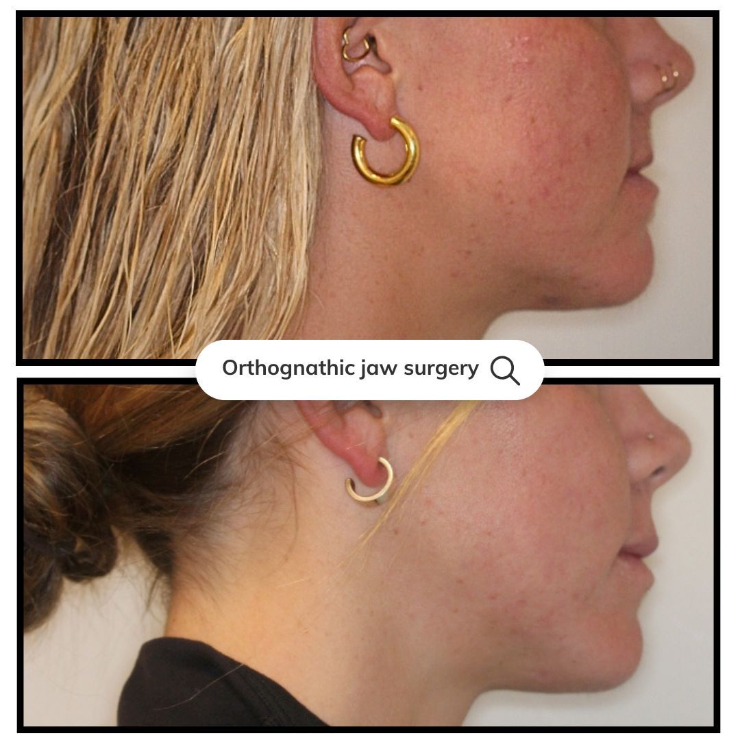 Side-by-side comparison: Jaw profile before and after orthognathic surgery.