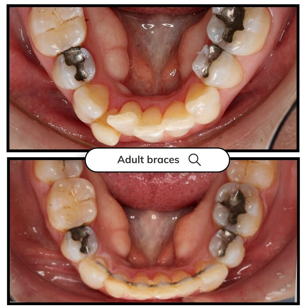 Comparison of teeth: before and after adult braces, showing crowded teeth straightening.