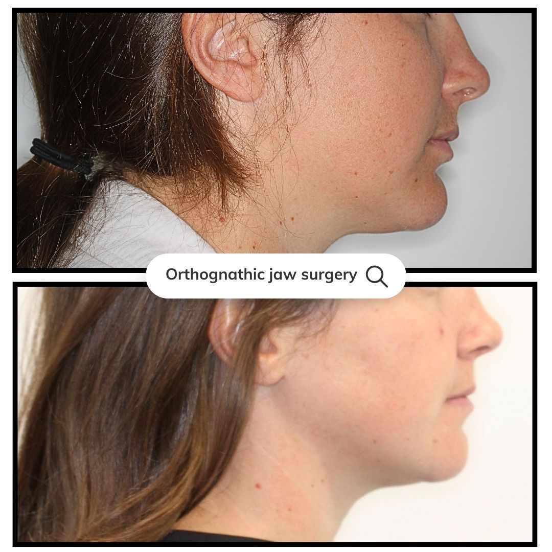 Before-and-after of a person's profile, showing jawline improvement after orthognathic surgery.